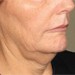 Chin Results - Before and After