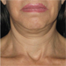 Neck Results - Before and After